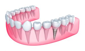 For dental implants in 85085, trust Dr. Anderson.