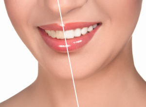 Woman's smile before and after whitening